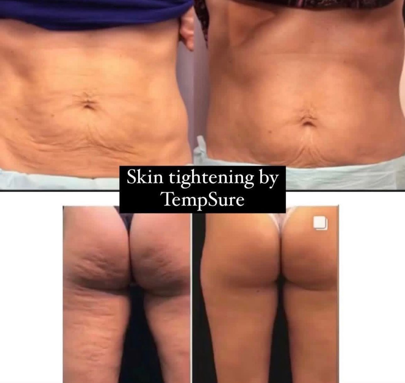Before and after photos of skin tightening on the abdomen and buttocks using TempSure technology.
