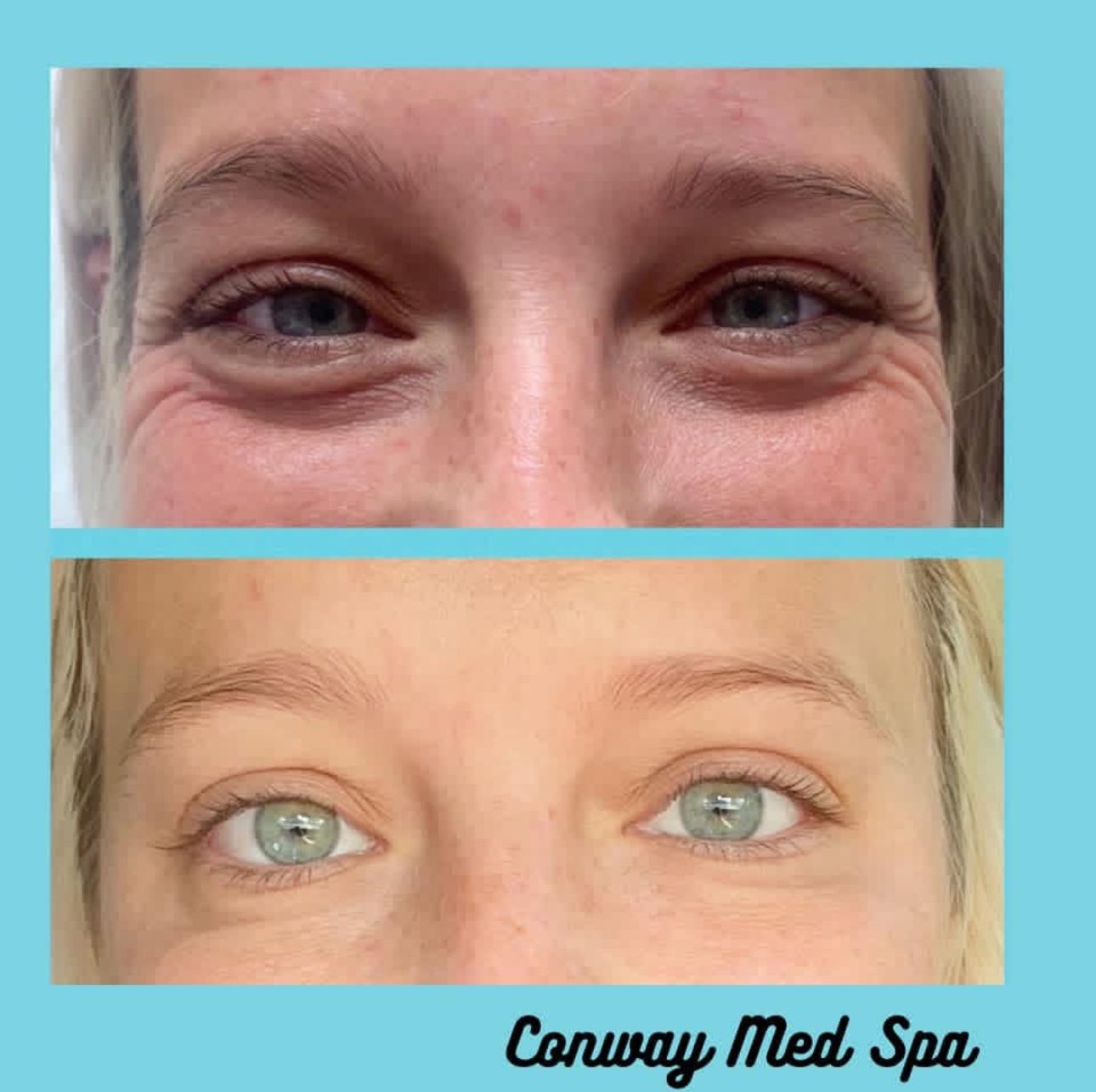 Before and after comparison of eyes showing reduced puffiness and fine lines after a medical spa treatment.