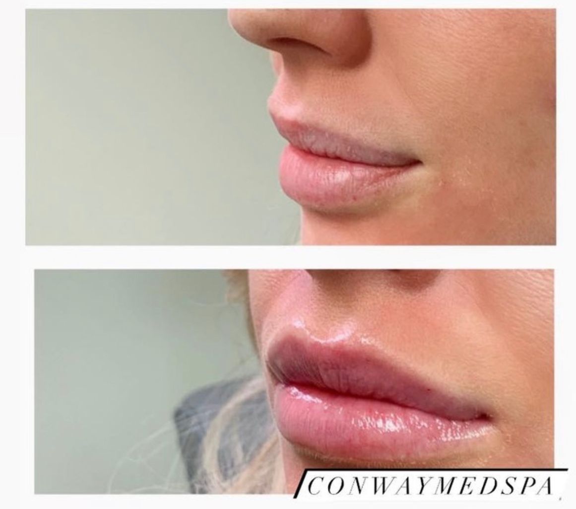 Before and after photos showing an increase in lip volume and definition following a cosmetic filler procedure.