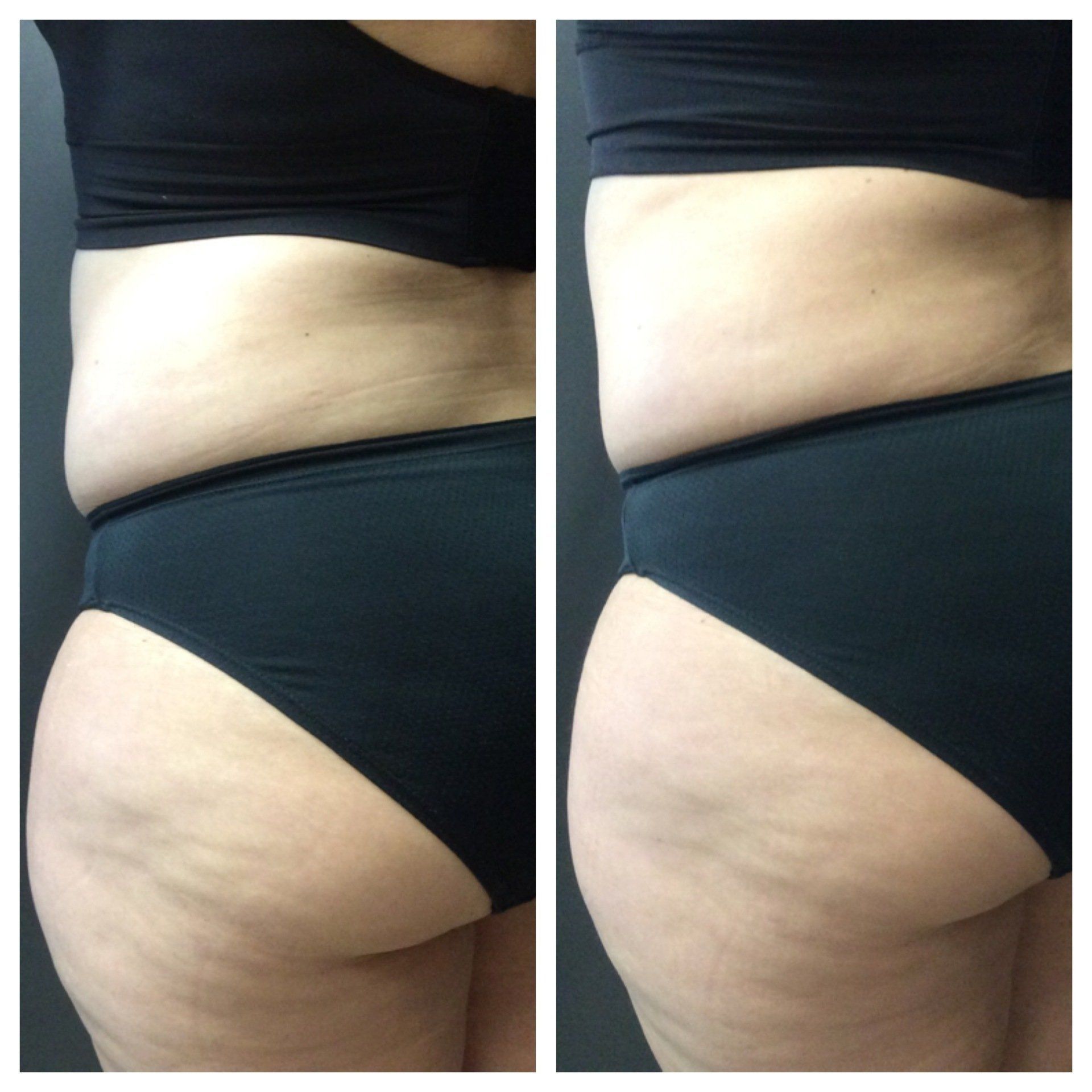 Before and after comparison of a person's side profile showing reduced waist and hip fat after a cosmetic treatment.