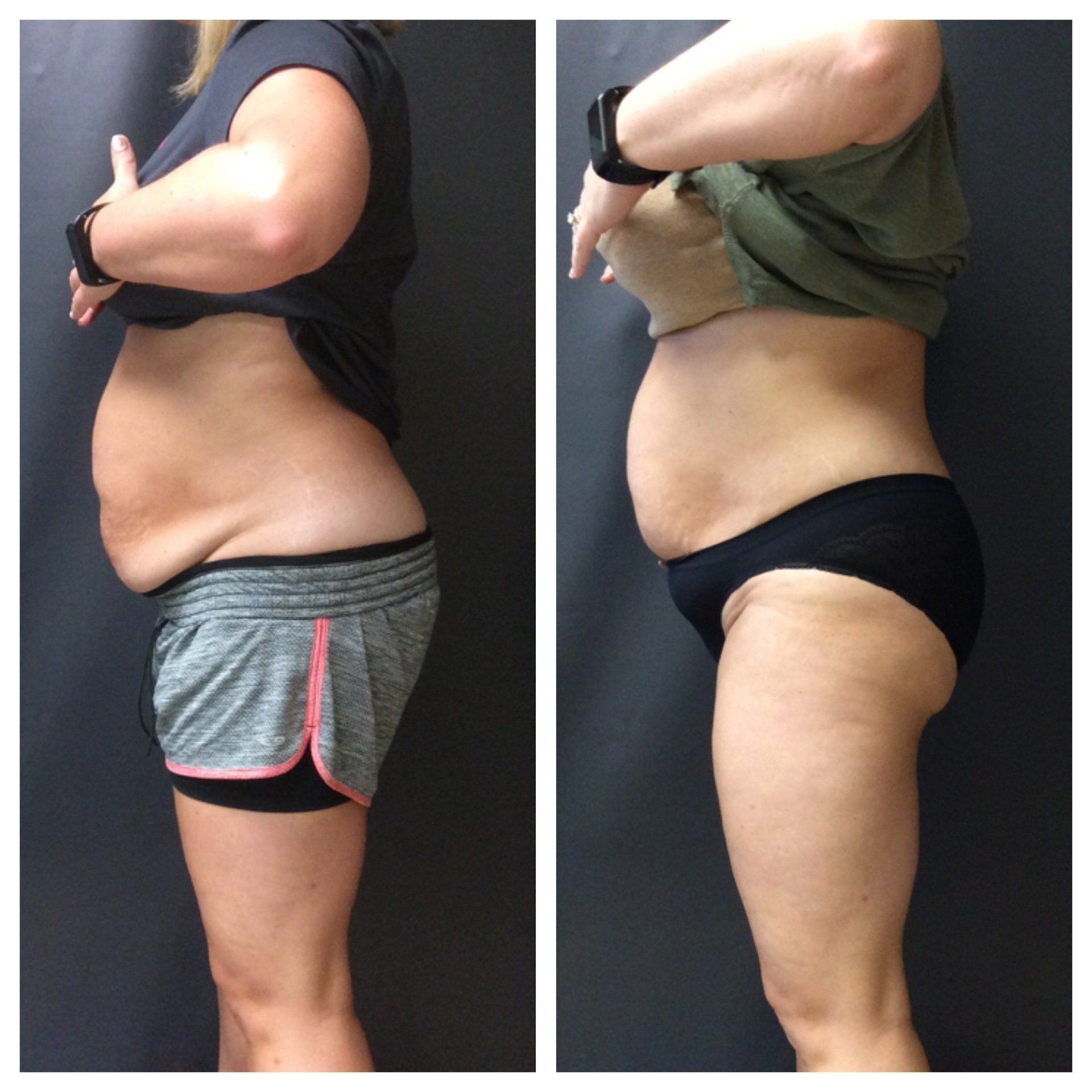 A side-by-side comparison showing the abdominal area before and after a body contouring procedure.