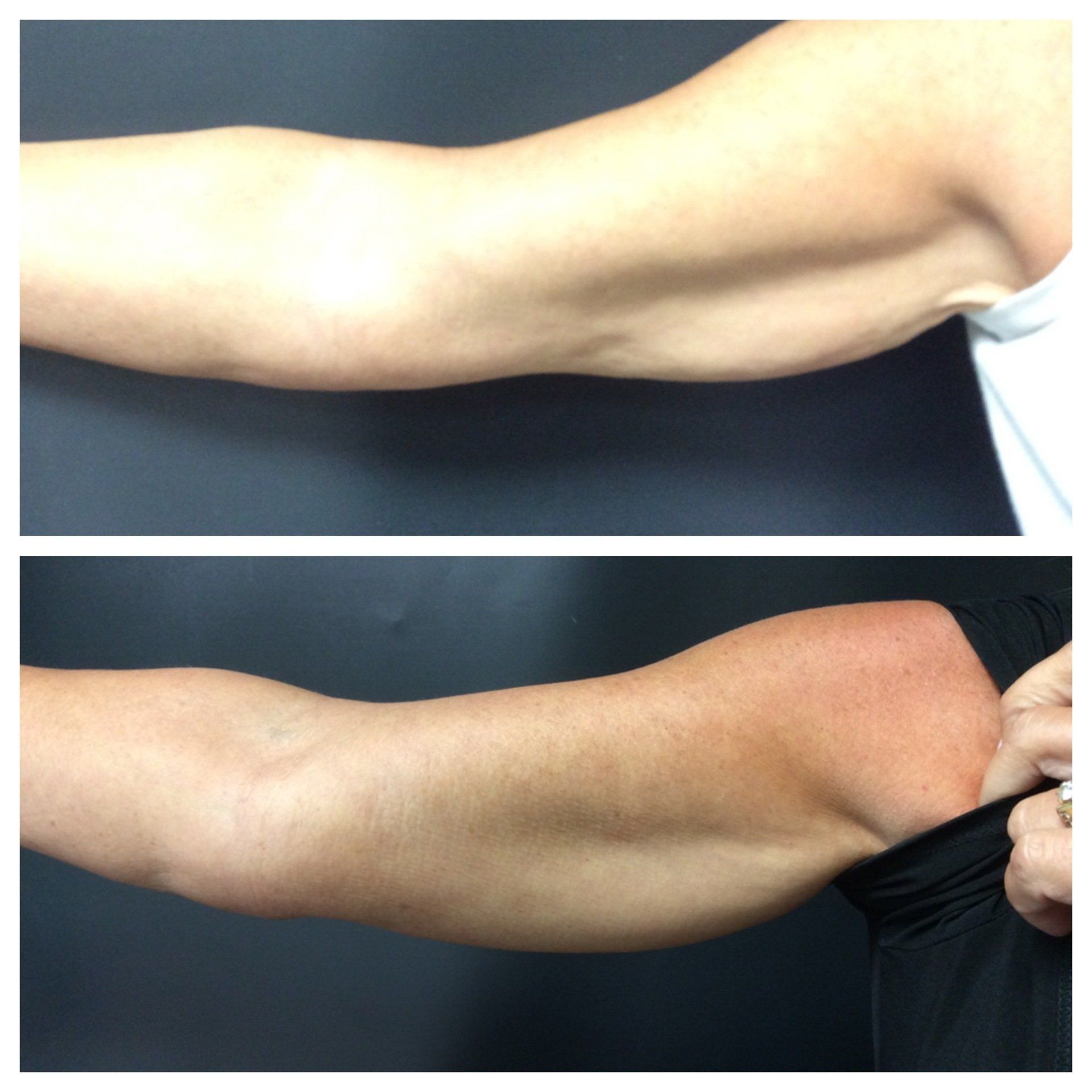 A before-and-after comparison of an upper arm, showing reduced skin laxity after a cosmetic procedure.