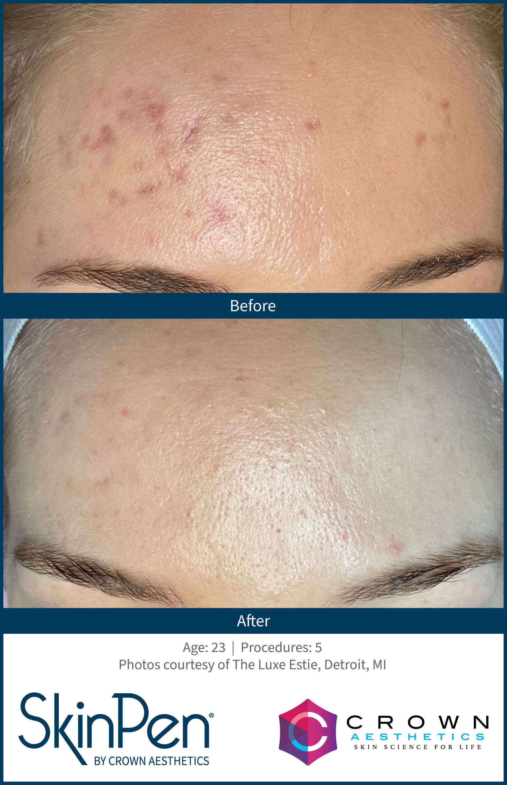 Before and after photos of a forehead showing improvement in skin texture and pigmentation following SkinPen treatment.
