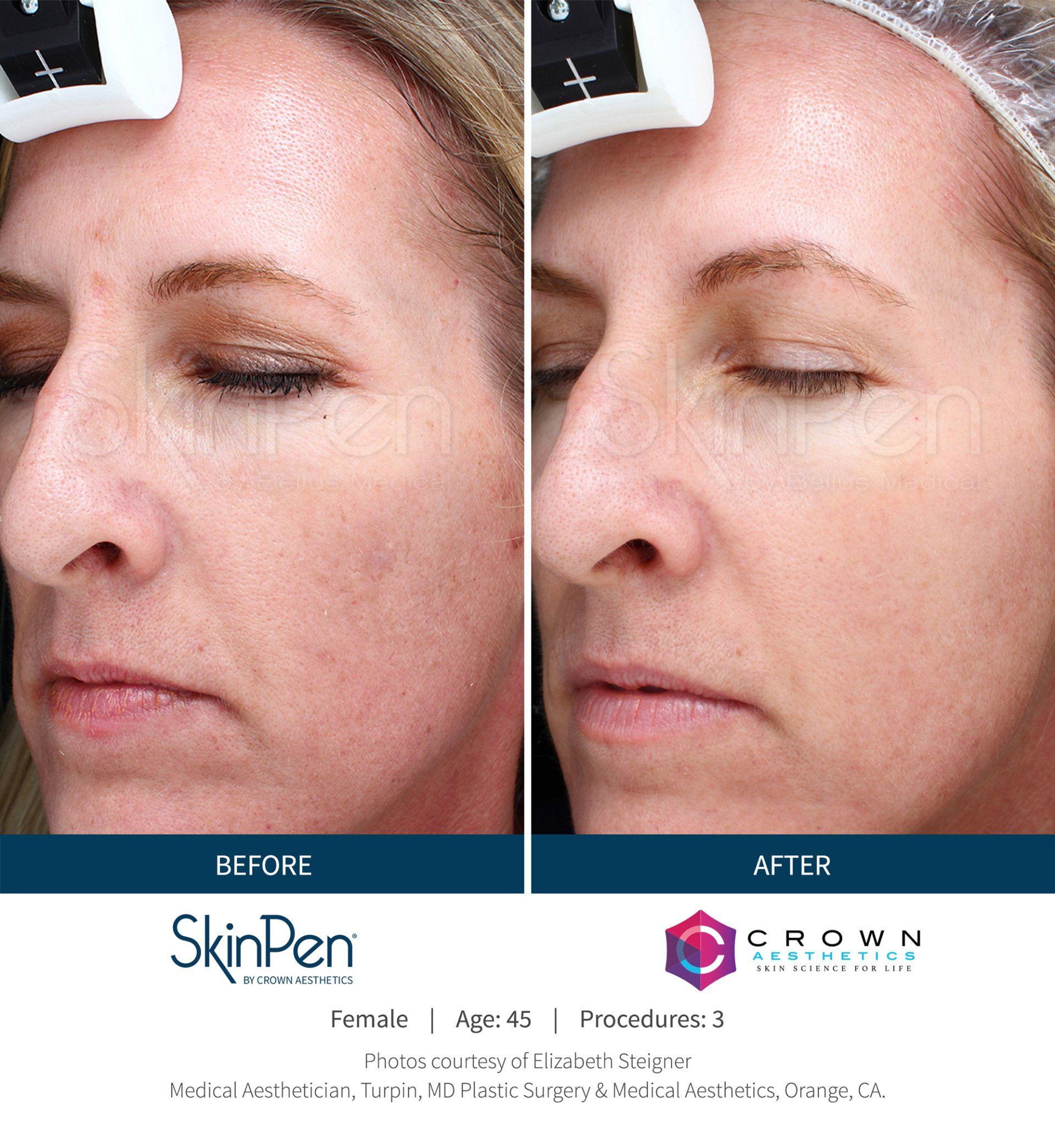 Before-and-after comparison showing skin texture improvement after SkinPen microneedling treatment.