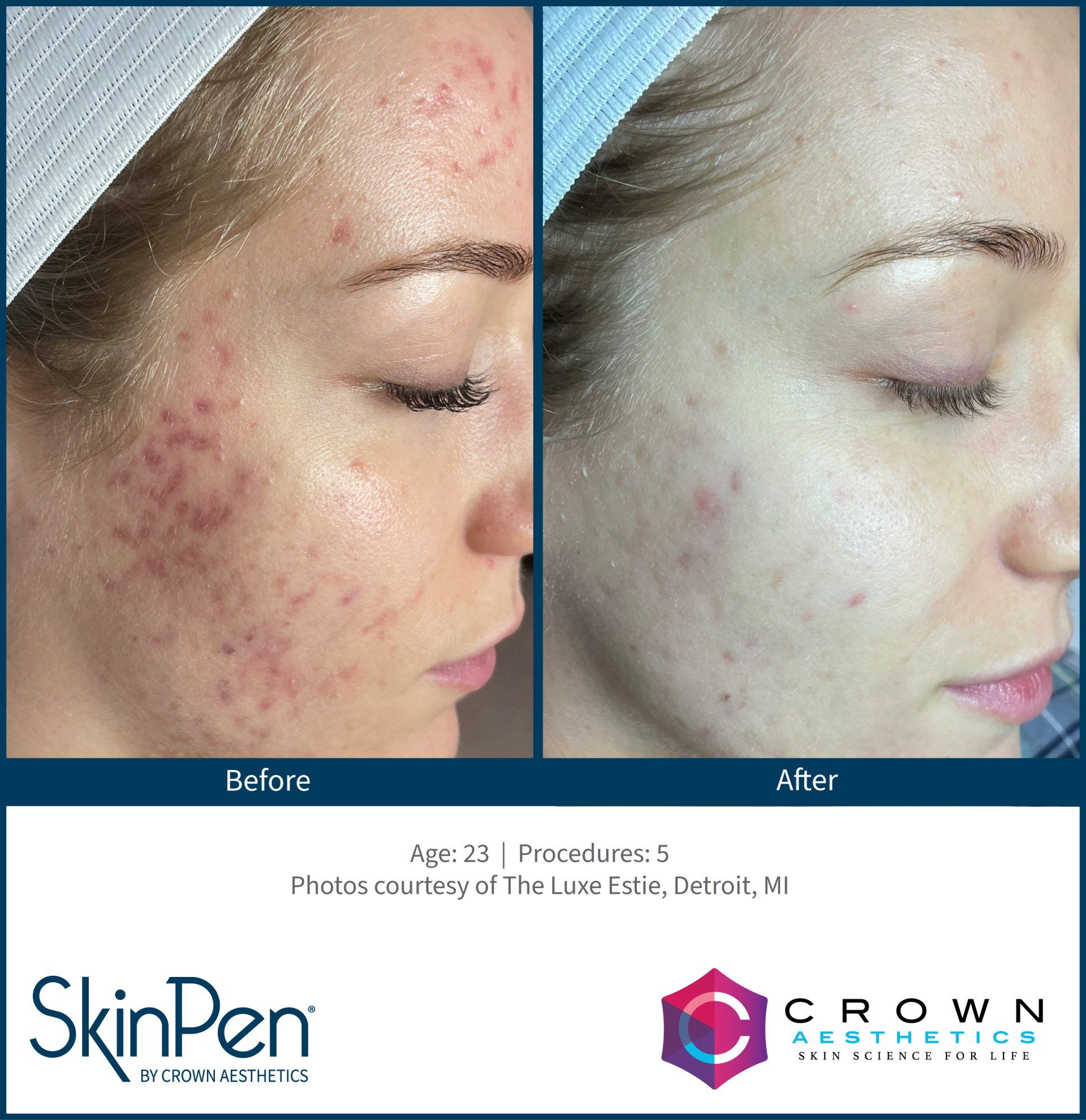 Before and after photos of a person's cheek showing improved skin texture and reduced acne after five SkinPen treatments.