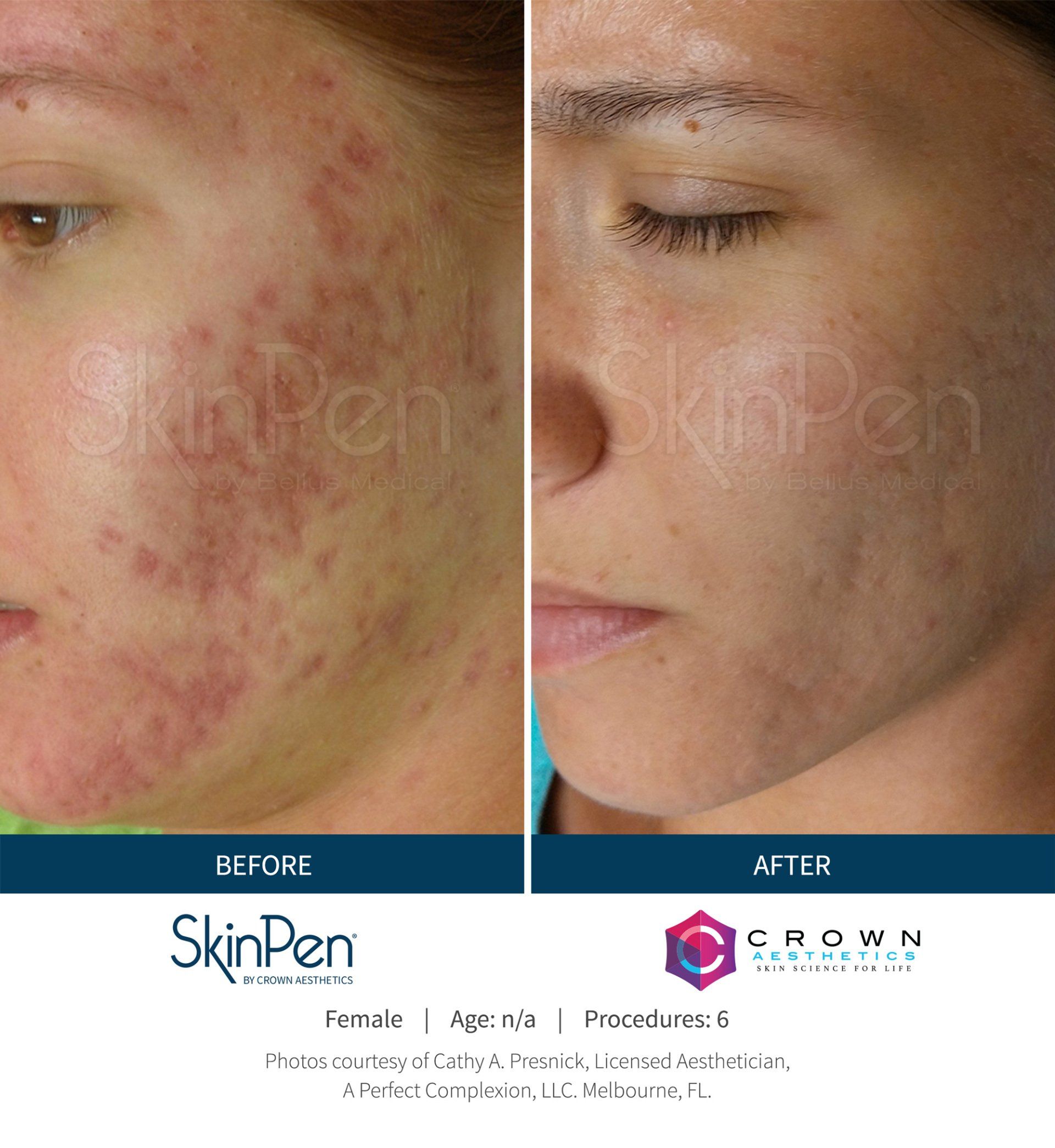 Before and after comparison of a person's cheek showing reduction in acne scarring following SkinPen microneedling.