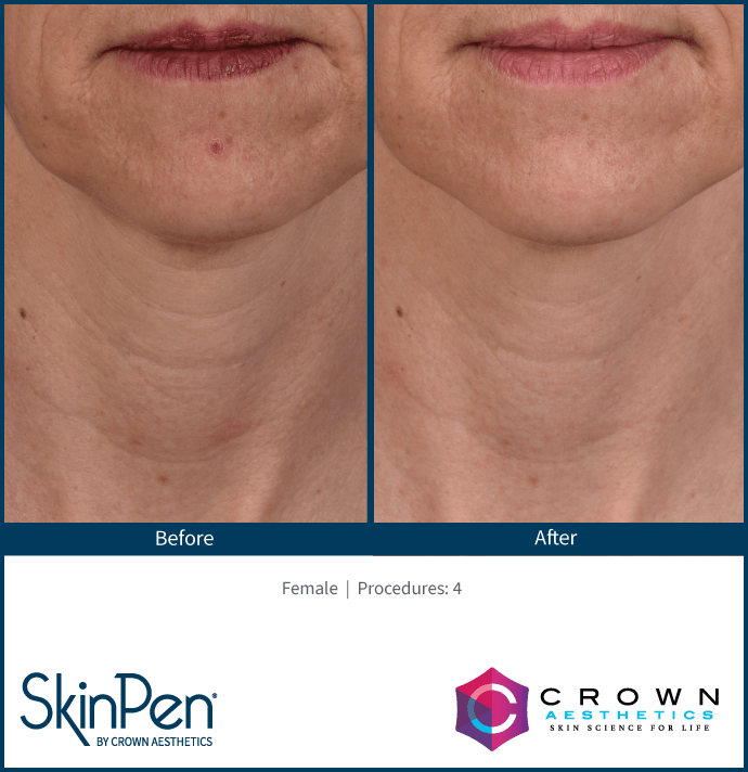 Before and after comparison showing a neck and chin area improved by four SkinPen microneedling procedures.