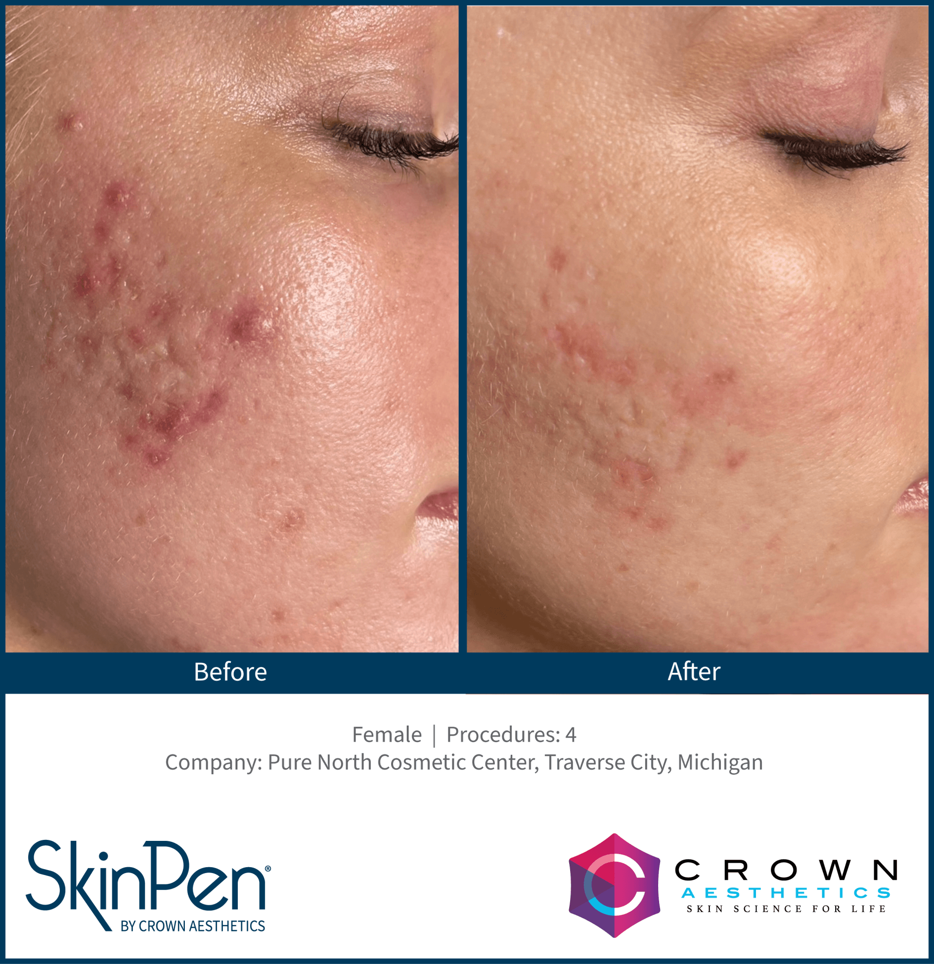 Before and after comparison of facial acne scarring treatment using SkinPen at Pure North Cosmetic Center.