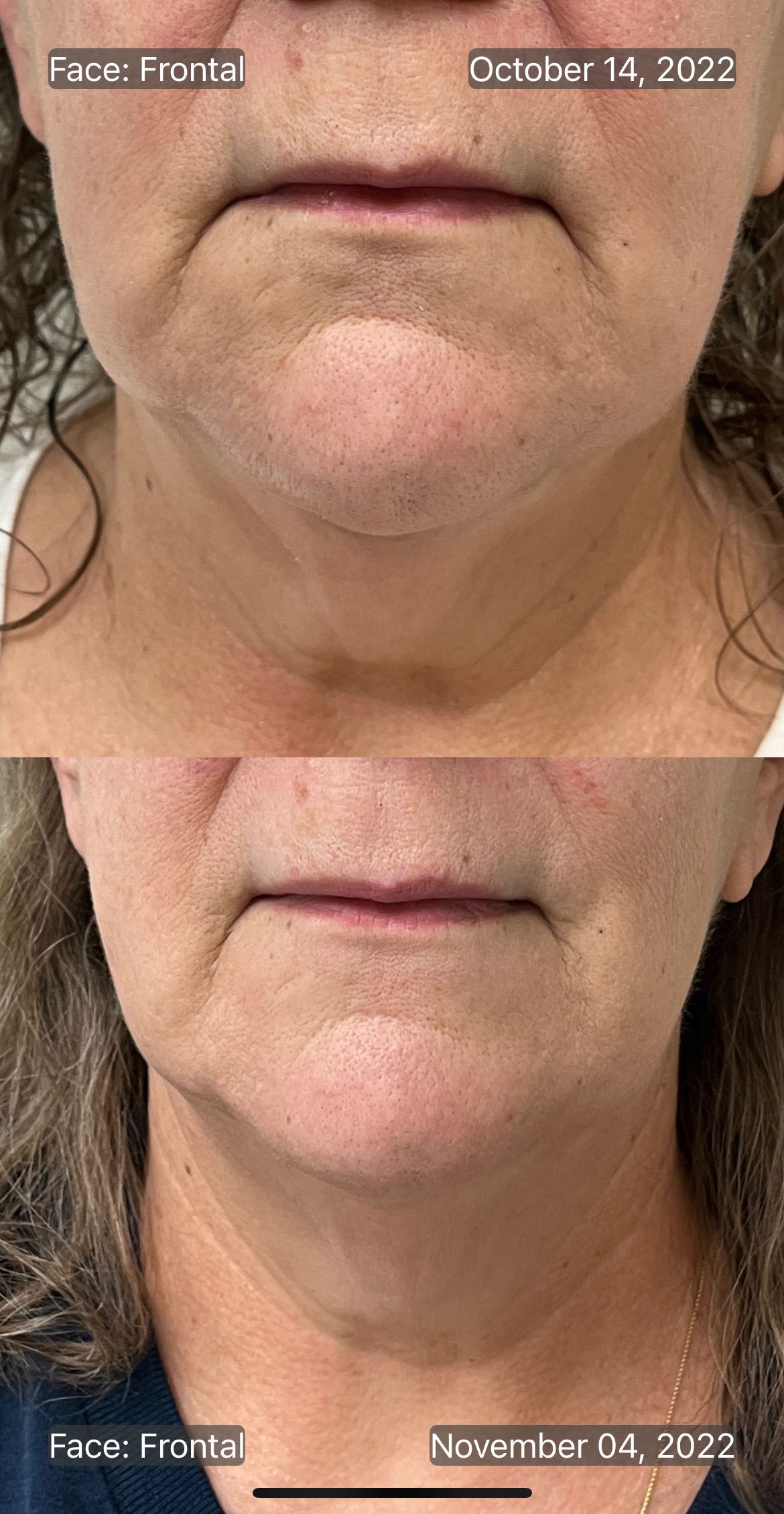 Before-and-after comparison of lower face and chin skin tightening, showing reduced lines and improved texture.