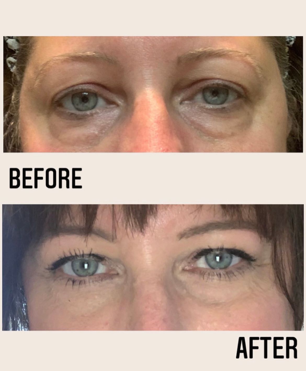 A before-and-after comparison showing reduced under-eye puffiness and improved skin texture around the eyes.