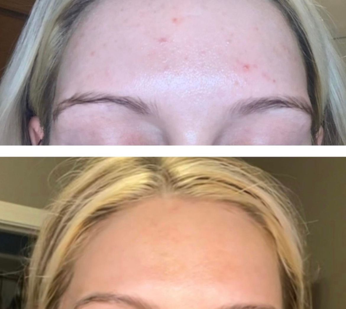 Before and after photos showing a clearer, smoother forehead after a skincare treatment or routine.