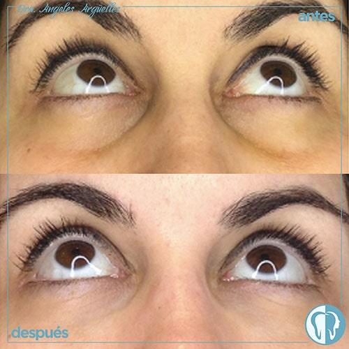 DRA. ÁNGELES ARGÜELLES MERCADO - Corrección de ojera