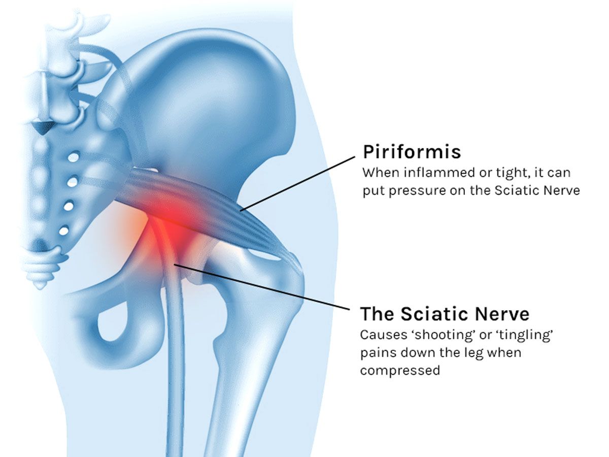 Is your Piriformis really to blame for your pain?