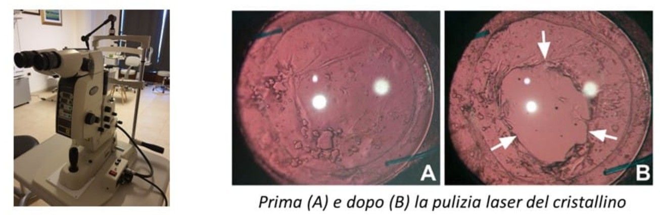 capsulotomia yag laser, pulizia cristallino, cataratta, cataratta secondaria, cristallino, corsano, oculista corsano