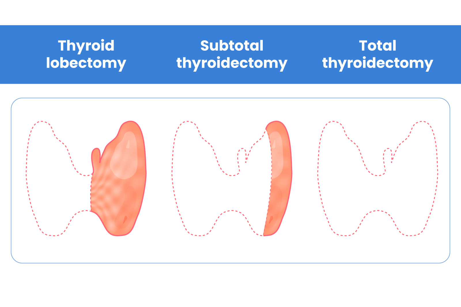 Understanding the Different Types of Thyroidectomy