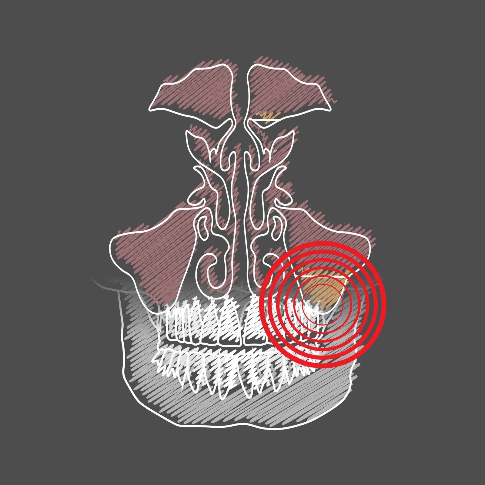 Turbinate Reduction