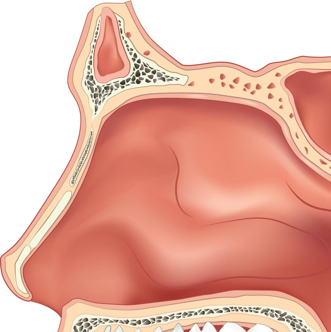 Palatal Implants