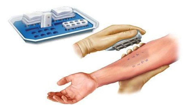 allergy skin testing