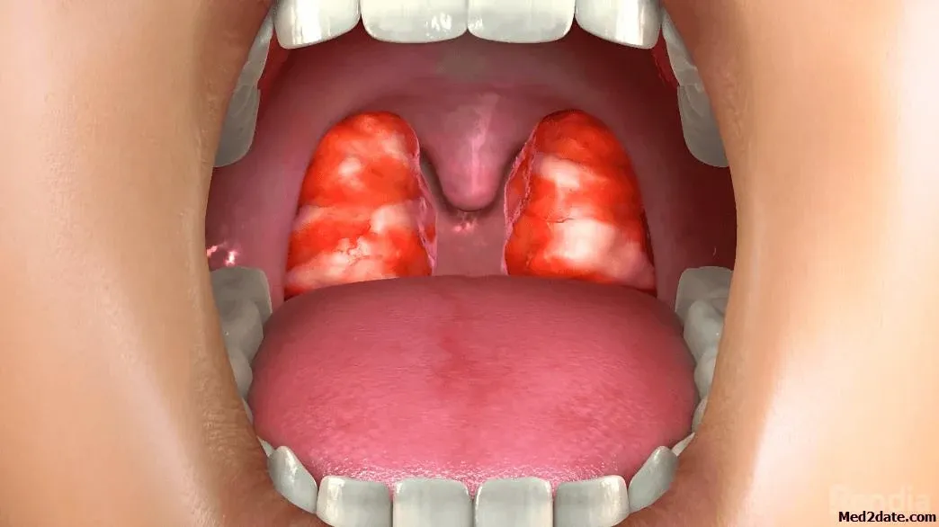 Trouble Swallowing - Bleeding Tonsils