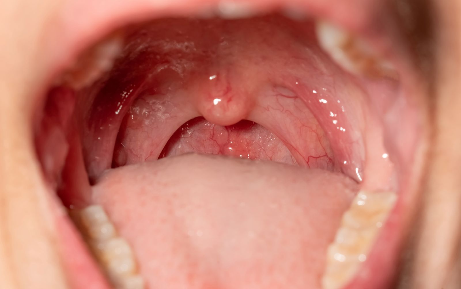 close up photo of the tonsils