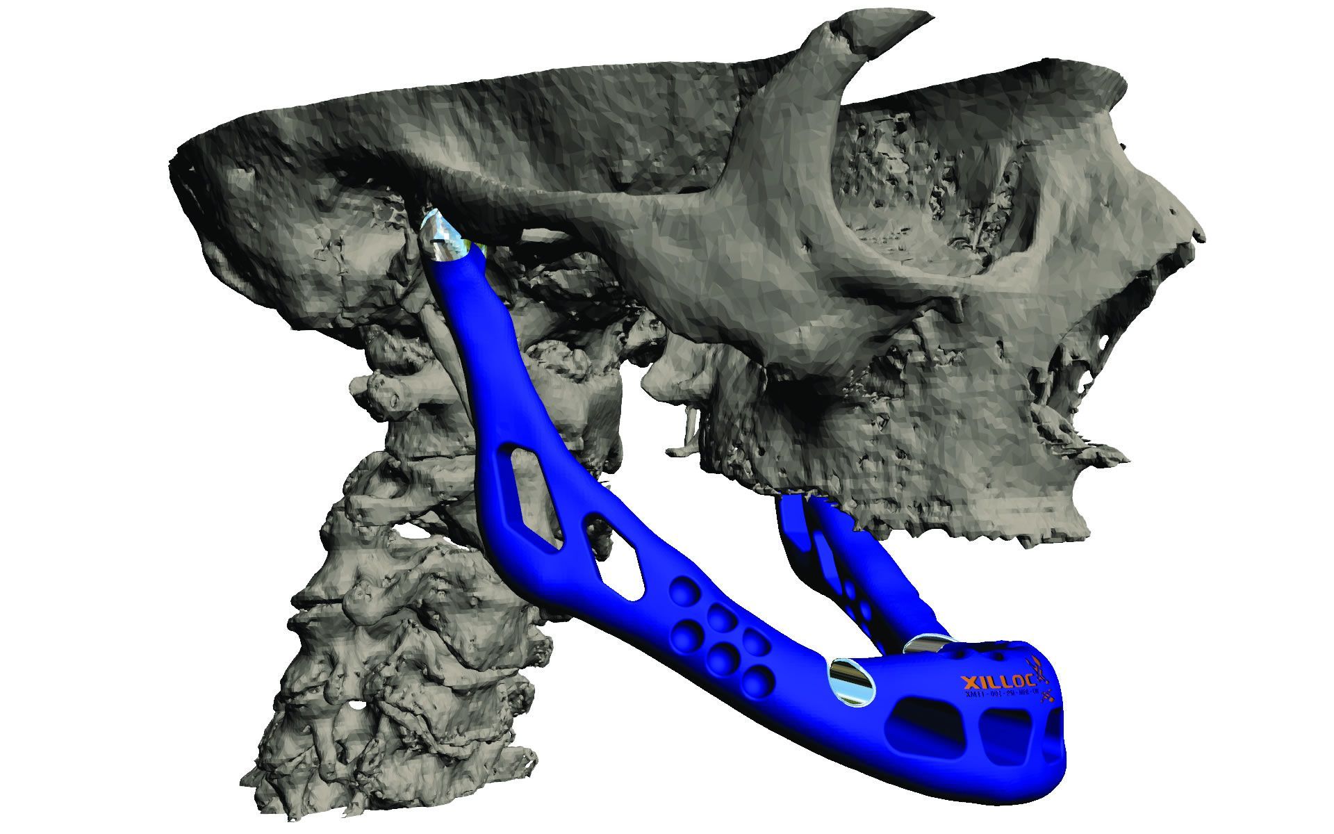 First 3D printed jaw transplant: 83-year-old woman sets world record (Video) 