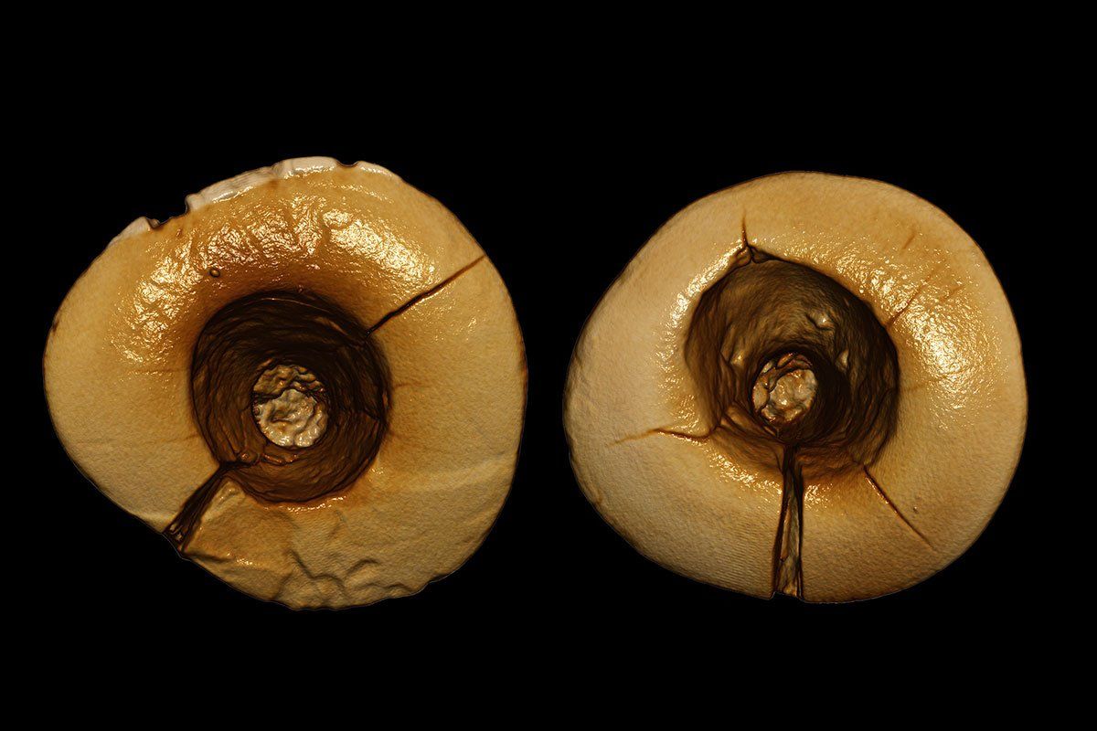 World's oldest dental fillings: Italy sets world record (VIDEO) World's oldest dental fillings: Italy sets world record (VIDEO)