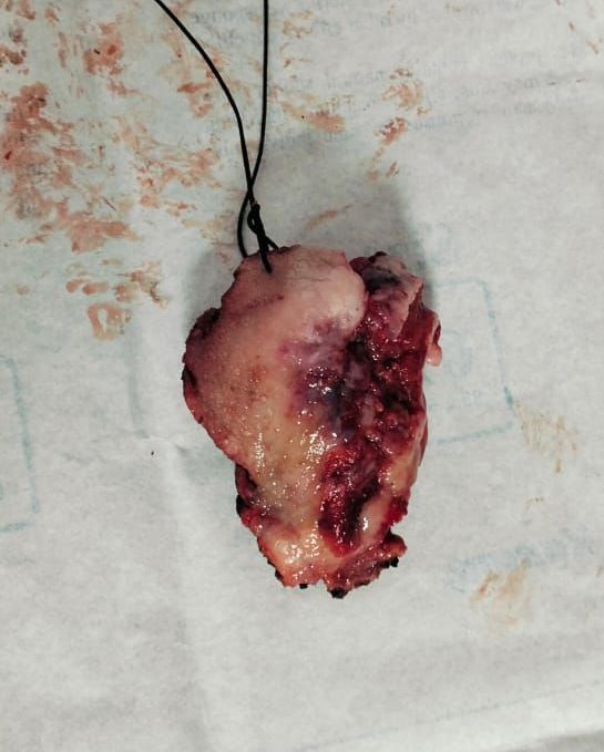 Tongue Cancer Surgery Zirakpur