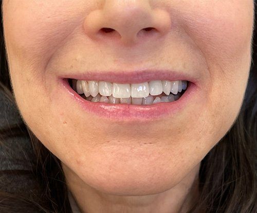After whitening treatment