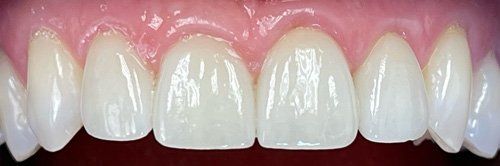 after tooth whitening