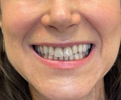 Before whitening treatment