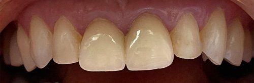 before tooth whitening