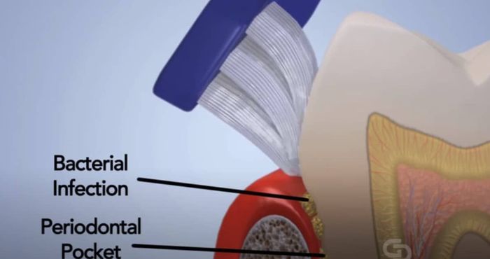A diagram of a tooth showing the bacterial infection and periodontal pocket