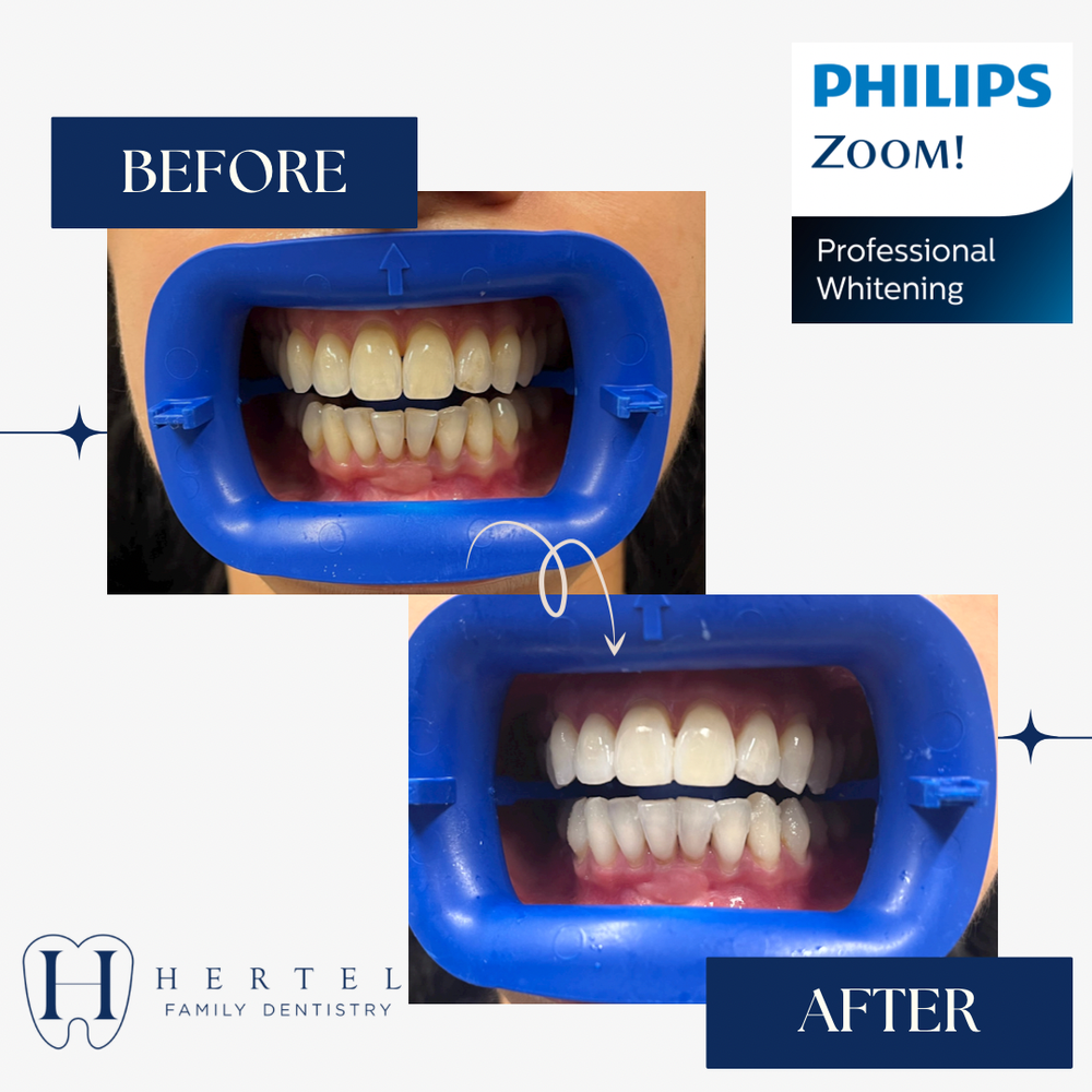 Dental Work Gallery Buffalo, NY Hertel Family Dentistry