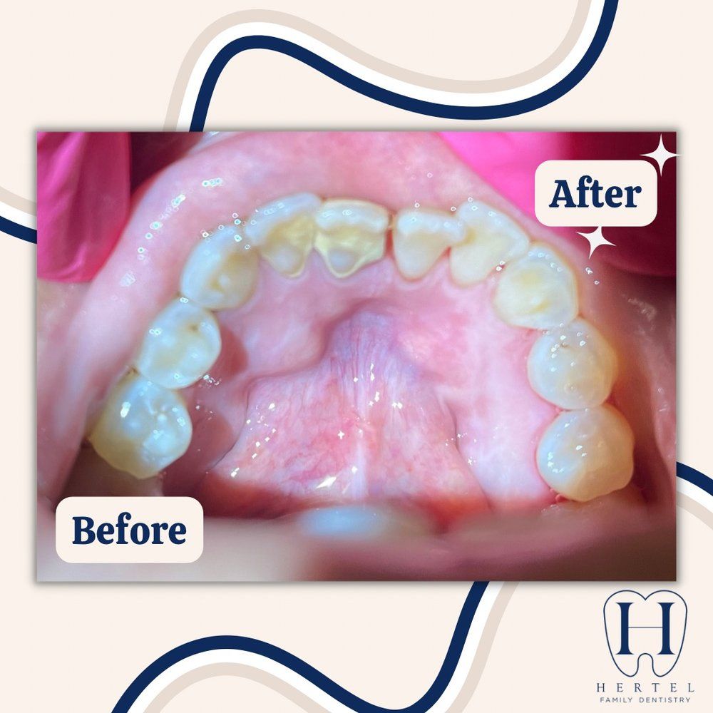 Dental Work Gallery Buffalo, NY Hertel Family Dentistry