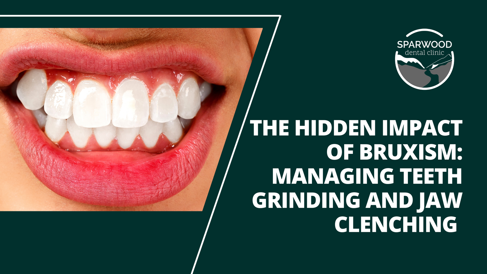 The hidden impact of bruxism : managing teeth grinding and jaw clenching