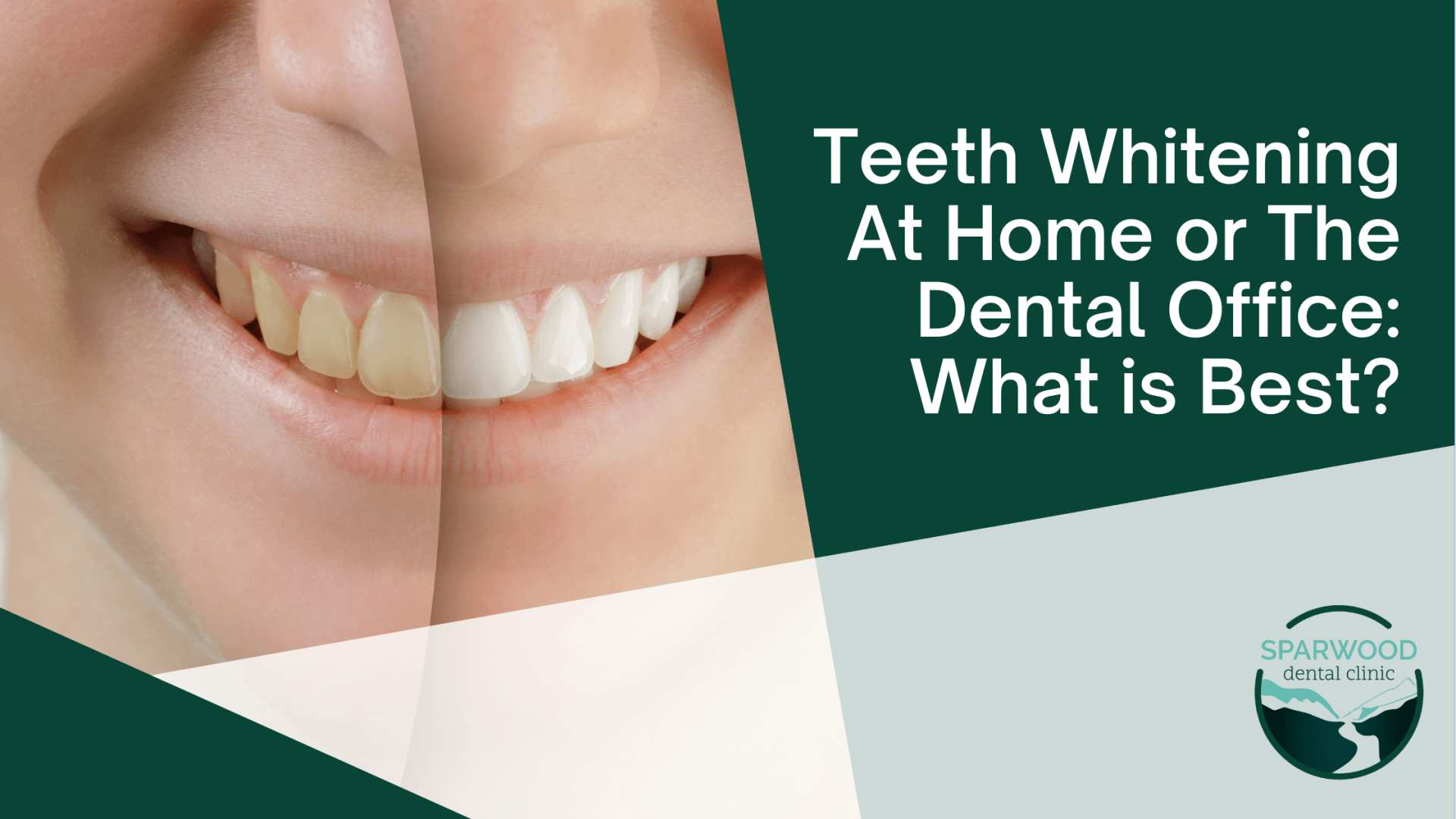 Teeth whitening at home or the dental office : what is best ?