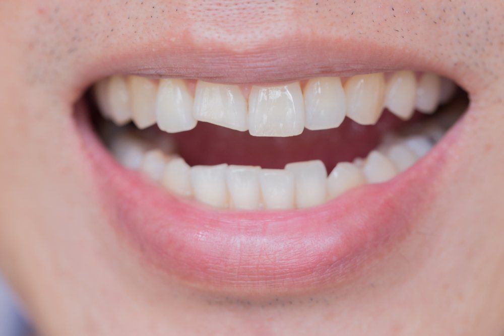 Close-up of a smiling mouth showing teeth, with one upper front tooth missing