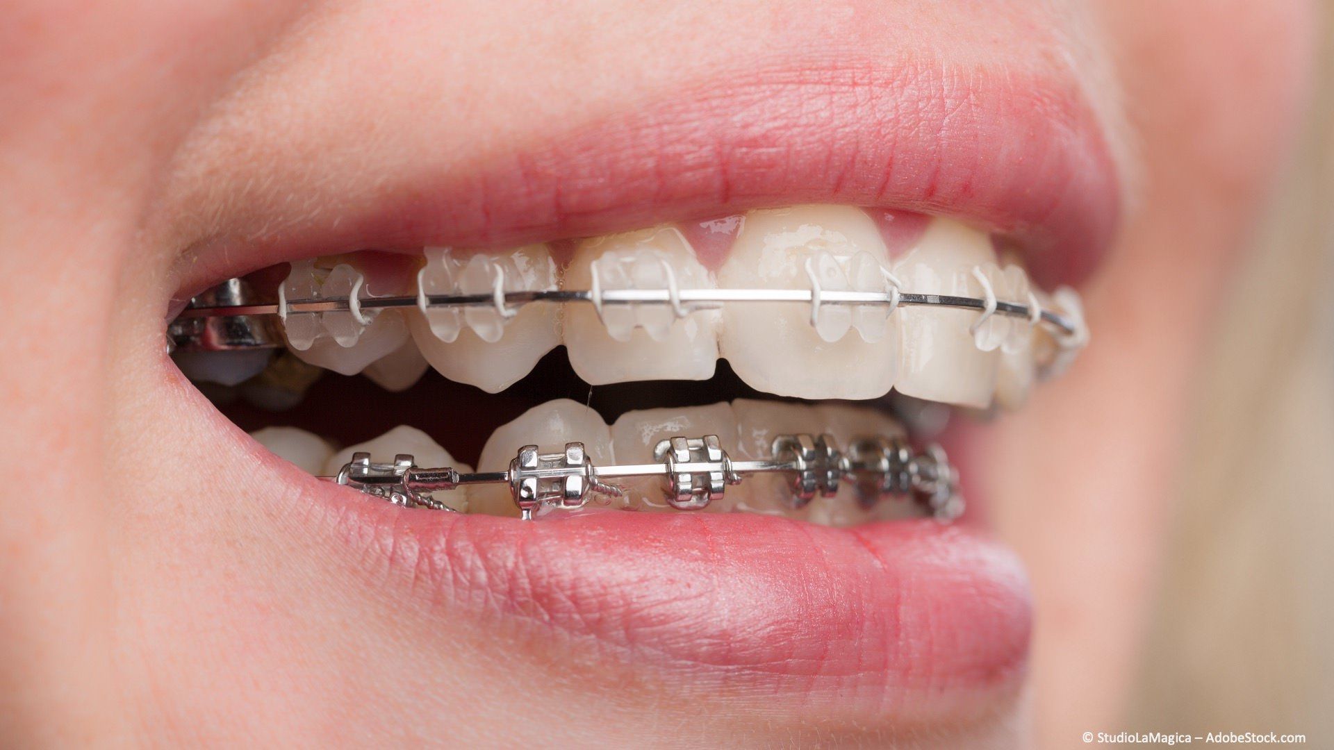 Festsitzende Zahnspangen mit Brackets und Drahtbögen Festsitzende Zahnspangen mit Brackets und Drahtbögen