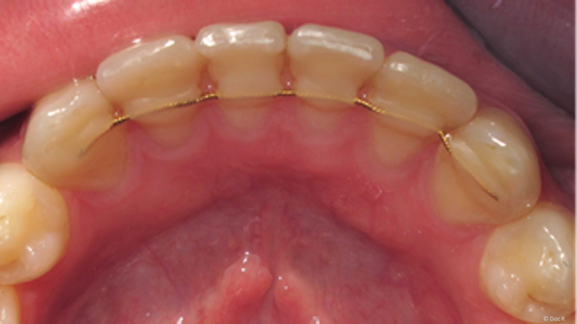 Drahtbogen als Retainer