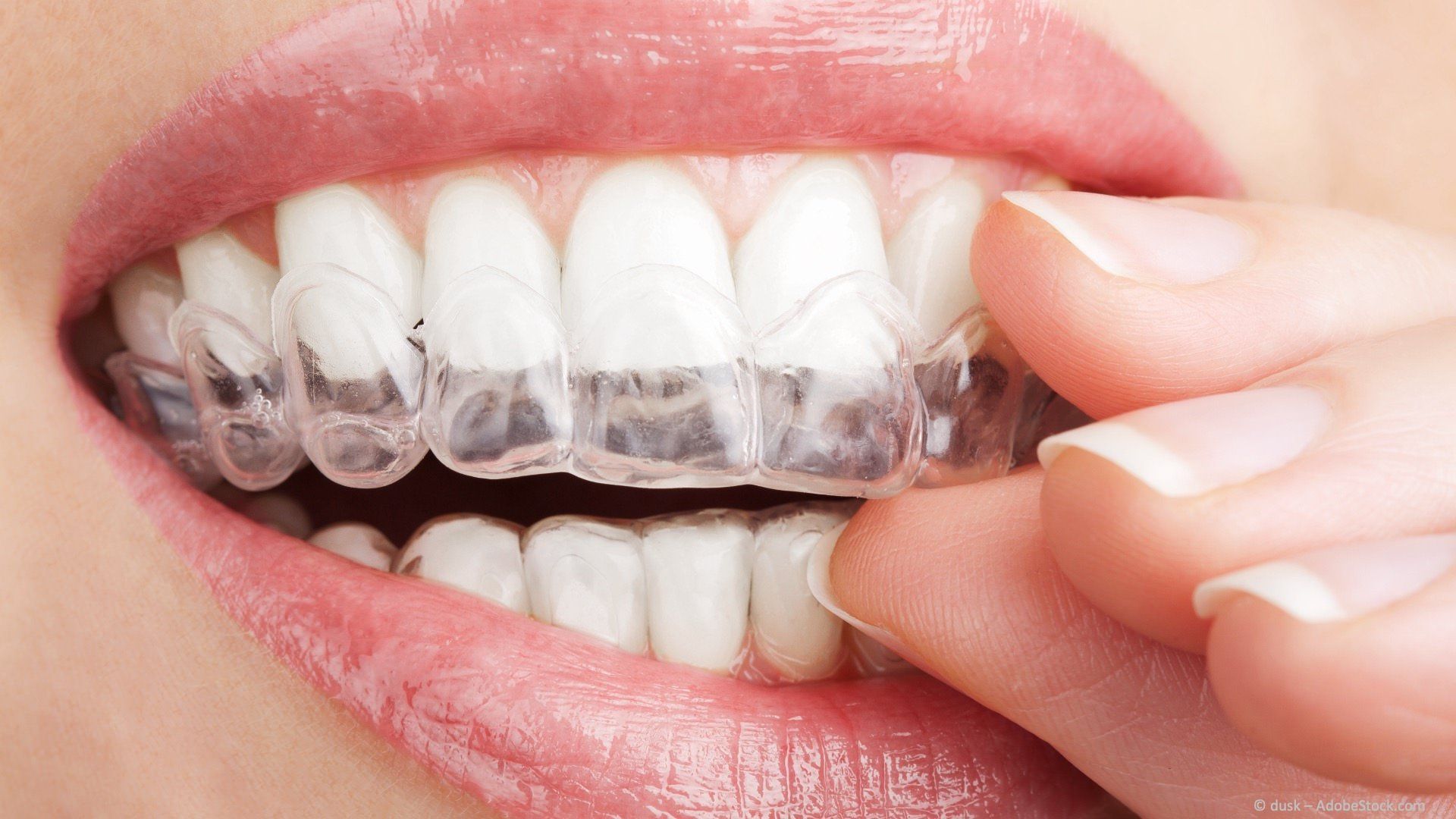 Aligner: transparente Folien zur Zahnregulierung Aligner: transparente Folien zur Zahnregulierung