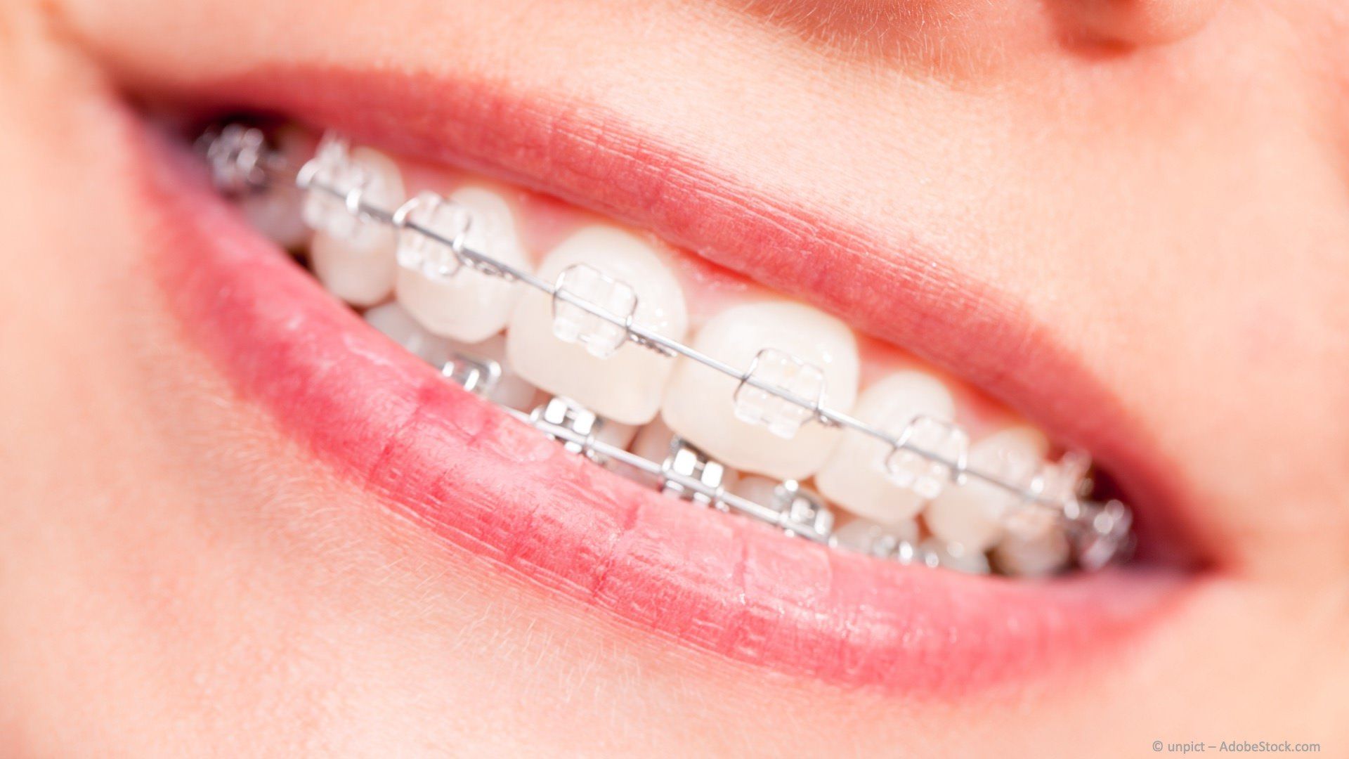 Festsitzende Zahnspange mit transparenten Brackets Festsitzende Zahnspange mit transparenten Brackets