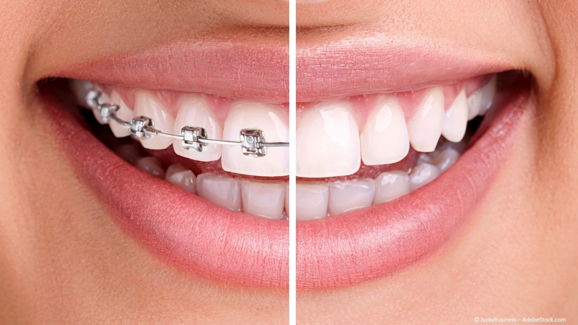 Brackets auf der Außen- und auf der Innenseite der Zähne