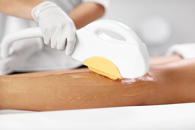 epilazione laser