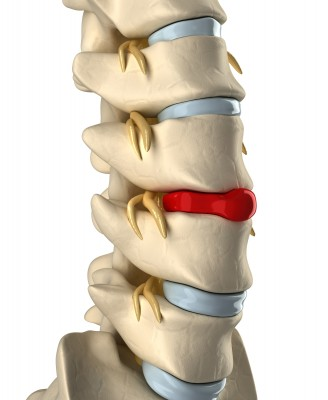 Side view of spine vertebrae with a red highlighted bulging disc