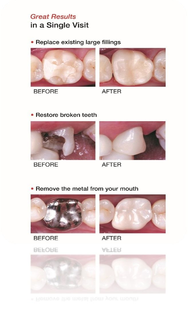 Before And After — Rochester, MN — Broadway Dental Care Before And After — Rochester, MN — Broadway Dental Care