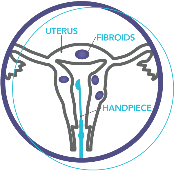 Gynecological Equipment — Novasure in Manchester, NH Gynecological Equipment — Novasure in Manchester, NH
