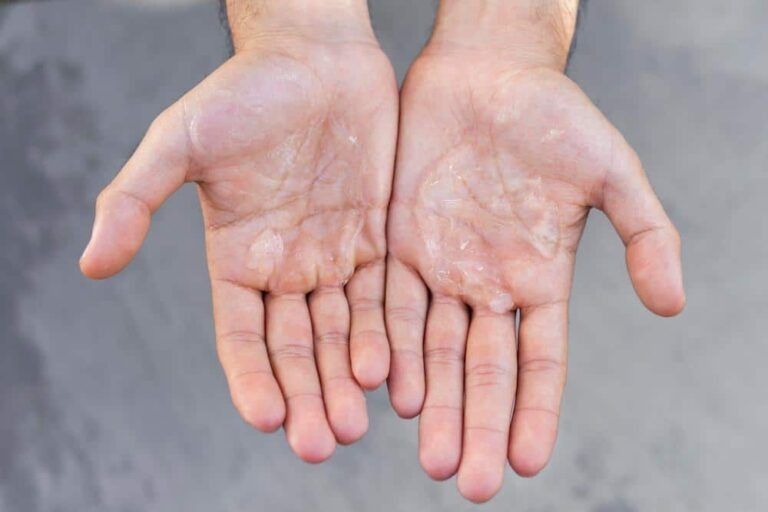 Open, sweaty palms against a gray background.
