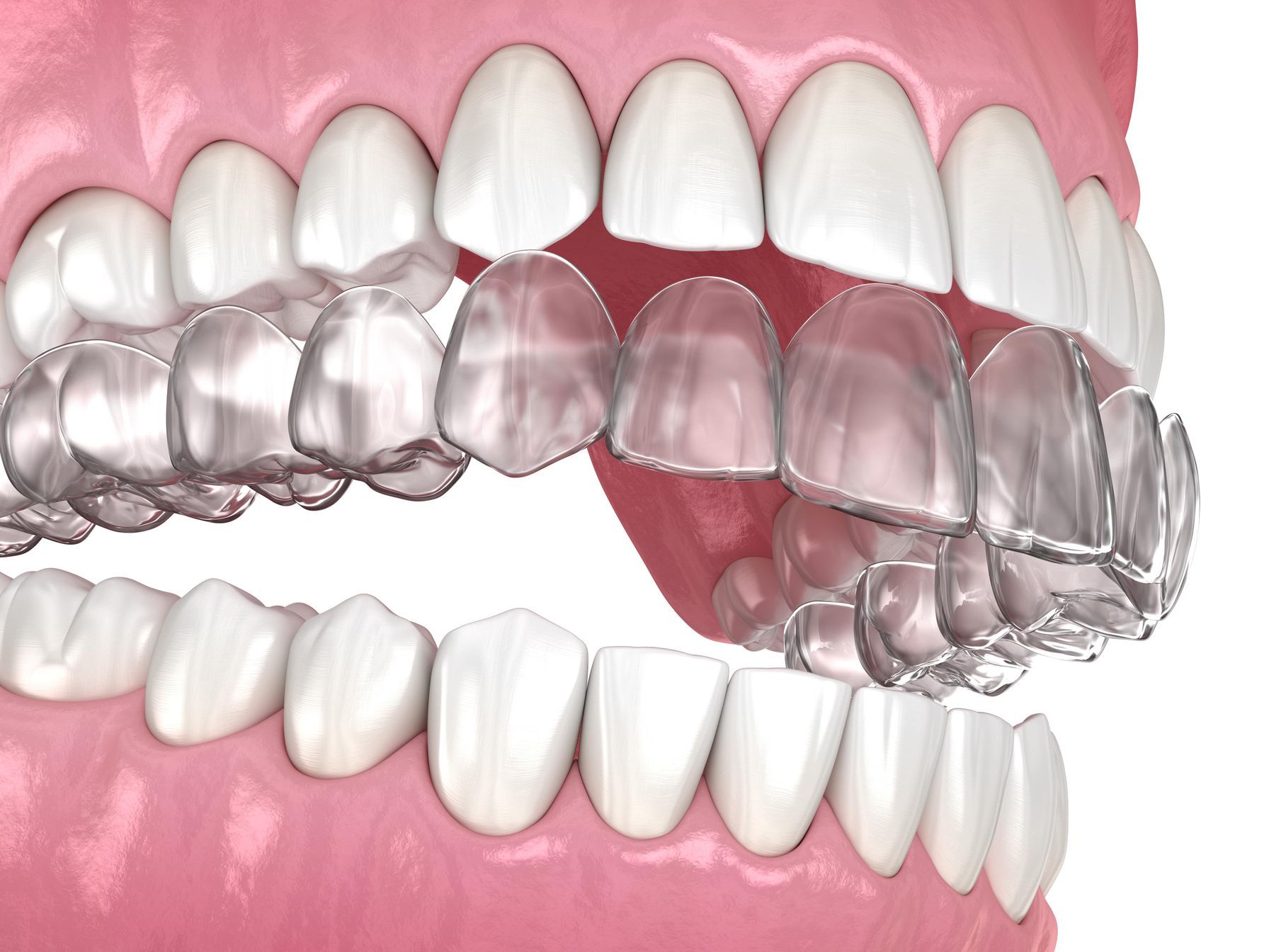 Clear aligners