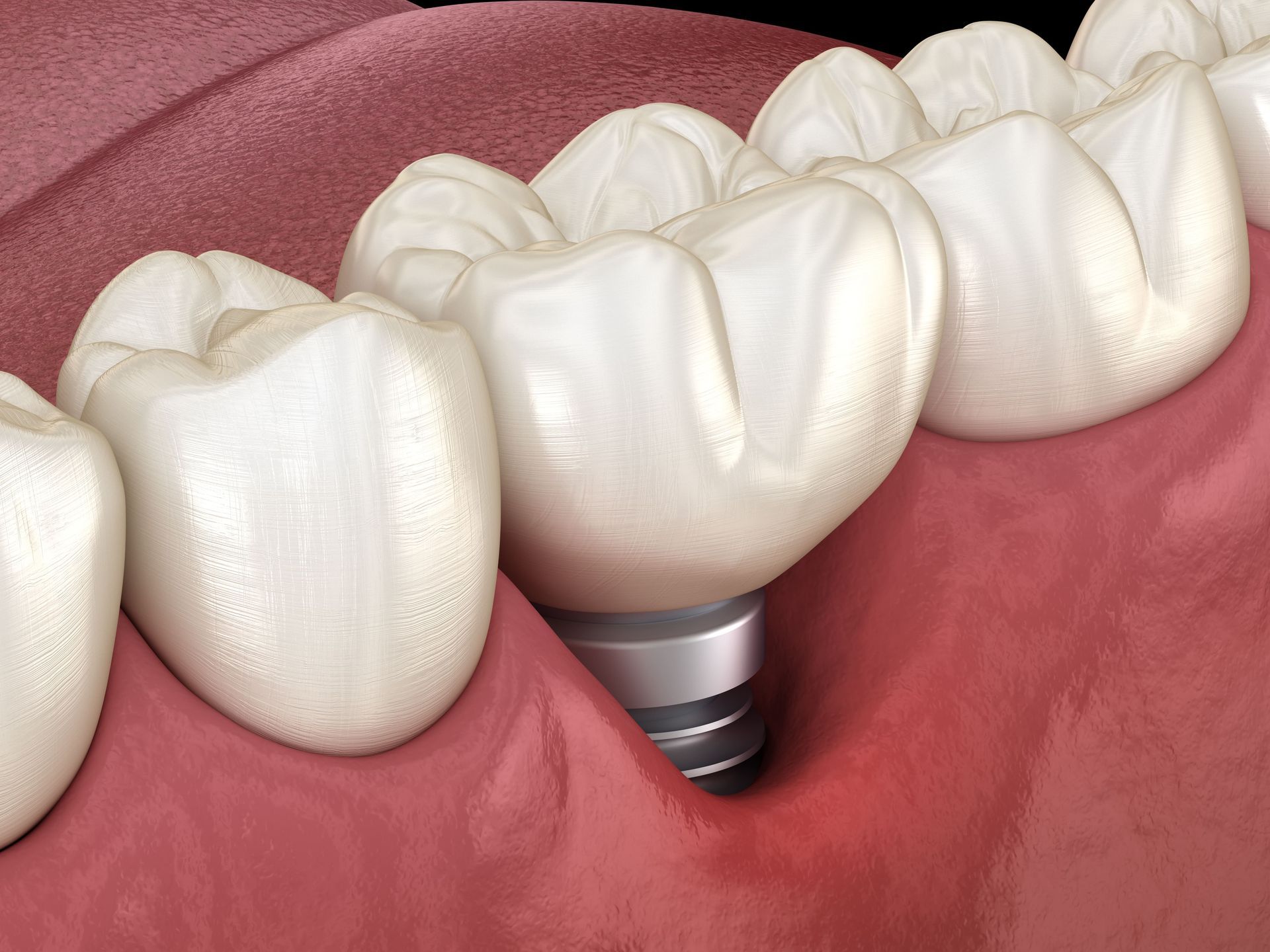 Implant repair