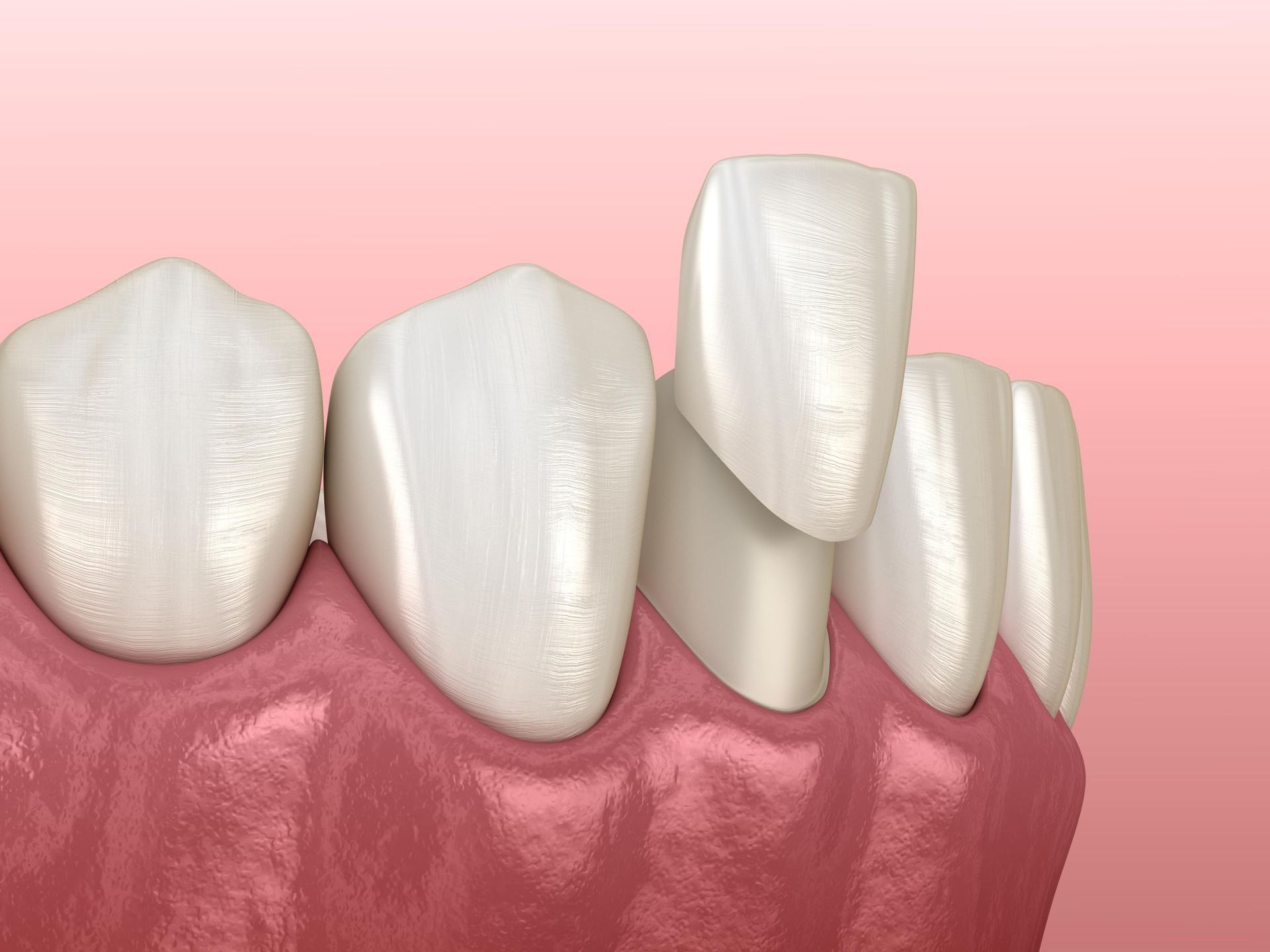 Porcelain Veneers